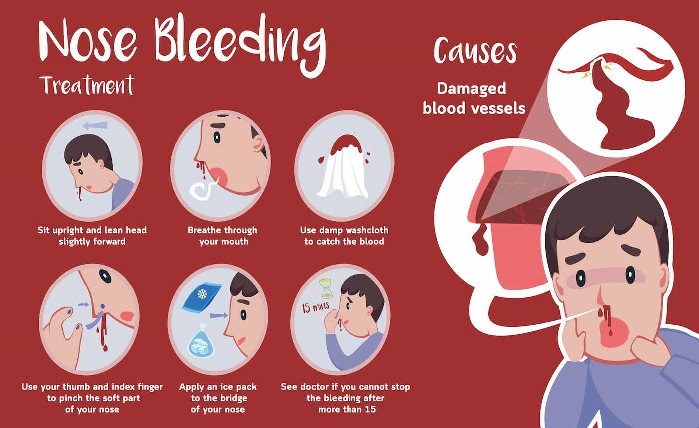Nosebleeds Epistaxis in Children Causes Risk Factors and How to Stop Them